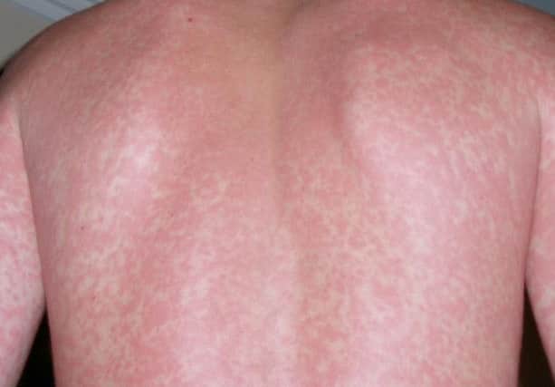 Scarlet fever rash PNL-160203-105727001